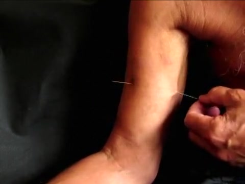 Needle intra biceps, Pain in my arm